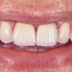 Zobne luske so učinkovita rešitev za številne težave z zobmi